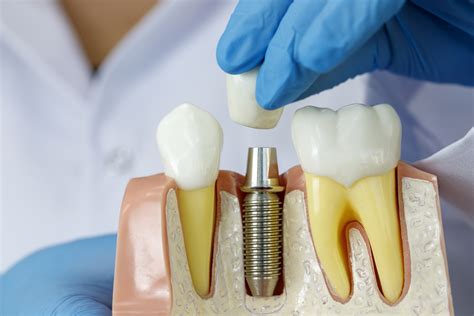 Doctors implants - I was familiar with All-on-4 dental implants but didn't have a dental specialist. I'm so glad... View Details. Compare Get a free consultation or call: (786) 756-8703. 25 mi. Santiago Lopez, DDS Dentist. 12 reviews. 131 NW 100th Ave., Plantation, Florida. 23 yrs exp.